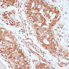 Immunohistochemistry of paraffin-embedded Human mammary cancer using PTPRN2 Polyclonal Antibody at dilution of  1:100 (40x lens).