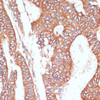 Immunohistochemistry of paraffin-embedded Human colon carcinoma using PTPRN2 Polyclonal Antibody at dilution of  1:100 (40x lens).
