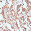 Immunohistochemistry of paraffin-embedded Human lung cancer using PTPRN2 Polyclonal Antibody at dilution of  1:100 (40x lens).