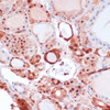 Immunohistochemistry of paraffin-embedded Human thyroid cancer using S100A5 Polyclonal Antibody at dilution of  1:100 (40x lens).