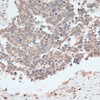 Immunohistochemistry of paraffin-embedded Human lung cancer using ZNF562 Polyclonal Antibody at dilution of  1:100 (40x lens).