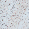 Immunohistochemistry of paraffin-embedded Human uterine cancer using ZNF433 Polyclonal Antibody at dilution of  1:100 (40x lens).