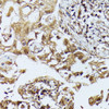 Immunohistochemistry of paraffin-embedded Human lung cancer using DAPK3 Polyclonal Antibody at dilution of  1:100 (40x lens).