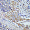 Immunohistochemistry of paraffin-embedded Human lung cancer using CTTN Polyclonal Antibody at dilution of  1:100 (40x lens).