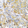 Immunohistochemistry of paraffin-embedded Human lung cancer using ZDHHC18 Polyclonal Antibody at dilution of  1:100 (40x lens).