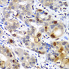 Immunohistochemistry of paraffin-embedded Human gastric cancer using SUMO2 Polyclonal Antibody at dilution of  1:100 (40x lens).