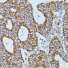 Immunohistochemistry of paraffin-embedded Human colon carcinoma using FLII Polyclonal Antibody at dilution of  1:100 (40x lens).