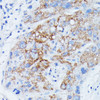 Immunohistochemistry of paraffin-embedded Human liver cancer using MANBA Polyclonal Antibody at dilution of  1:100 (40x lens).