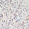 Immunohistochemistry of paraffin-embedded Human breast cancer using AFG3L2 Polyclonal Antibody at dilution of  1:200 (40x lens).