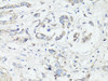 Immunohistochemistry of paraffin-embedded Human gastric cancer using LC3A / LC3B Polyclonal Antibody at dilution of  1:100 (40x lens).