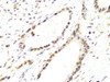Immunohistochemistry of paraffin-embedded Human colon carcinoma using Twist Polyclonal Antibody at dilution of  1:100 (40x lens).