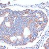 Immunohistochemistry of paraffin-embedded Human colon carcinoma using ITCH Polyclonal Antibody at dilution of  1:50 (40x lens).