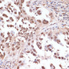 Immunohistochemistry of paraffin-embedded Human lung cancer using ITCH Polyclonal Antibody at dilution of  1:100 (40x lens).