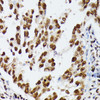 Immunohistochemistry of paraffin-embedded Human lung cancer using HNRNPD Polyclonal Antibody at dilution of  1:100 (40x lens).