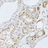 Immunohistochemistry of paraffin-embedded Human thyroid cancer using PPP2R5D Polyclonal Antibody at dilution of  1:100 (40x lens).