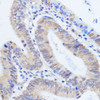 Immunohistochemistry of paraffin-embedded Human colon carcinoma using RBM39 Polyclonal Antibody at dilution of  1:100 (40x lens).