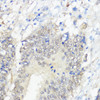 Immunohistochemistry of paraffin-embedded Human colon carcinoma using GPX2 Polyclonal Antibody at dilution of  1:100 (40x lens).