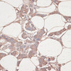 Immunohistochemistry of paraffin-embedded Human breast cancer using LAMC1 Polyclonal Antibody at dilution of  1:100 (40x lens).