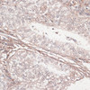 Immunohistochemistry of paraffin-embedded Human uterine cancer using LAMC1 Polyclonal Antibody at dilution of  1:100 (40x lens).