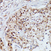 Immunohistochemistry of paraffin-embedded Human mammary cancer using IGHMBP2 Polyclonal Antibody at dilution of  1:100 (40x lens).