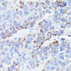 Immunohistochemistry of paraffin-embedded Human liver cancer using CCDC6 Polyclonal Antibody at dilution of  1:100 (40x lens).