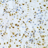 Immunohistochemistry of paraffin-embedded Human kidney cancer using HuR / ELAVL1 Polyclonal Antibody at dilution of  1:200 (40x lens).