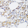 Immunohistochemistry of paraffin-embedded Human breast cancer using USP33 Polyclonal Antibody at dilution of  1:100 (40x lens).