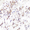 Immunohistochemistry of paraffin-embedded Human gastric cancer using SELL Polyclonal Antibody at dilution of  1:100 (40x lens).