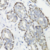 Immunohistochemistry of paraffin-embedded Human breast cancer using WASF3 Polyclonal Antibody at dilution of  1:100 (40x lens).