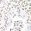 Immunohistochemistry of paraffin-embedded Human lung cancer using CDX2 Polyclonal Antibody at dilution of  1:100 (40x lens).