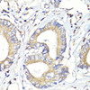 Immunohistochemistry of paraffin-embedded Human colon carcinoma using HBEGF Polyclonal Antibody at dilution of  1:100 (40x lens).