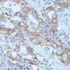 Immunohistochemistry of paraffin-embedded Human lung cancer using FGD1 Polyclonal Antibody at dilution of  1:100 (40x lens).
