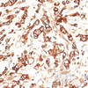 Immunohistochemistry of paraffin-embedded Human breast cancer using KRT13 Polyclonal Antibody at dilution of  1:100 (40x lens).