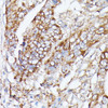Immunohistochemistry of paraffin-embedded Human colon carcinoma using NUBP1 Polyclonal Antibody at dilution of  1:100 (40x lens).