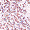 Immunohistochemistry of paraffin-embedded Human thyroid cancer using MRPL23 Polyclonal Antibody at dilution of  1:100 (40x lens).
