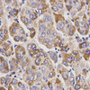 Immunohistochemistry of paraffin-embedded Human liver cancer using UGT1A9 Polyclonal Antibody at dilution of  1:200 (40x lens).