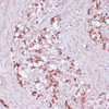 Immunohistochemistry of paraffin-embedded Human oophoroma using UGT2B15 Polyclonal Antibody at dilution of  1:100 (40x lens).