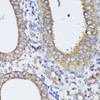 Immunohistochemistry of paraffin-embedded Human uterine cancer using ERK1 / ERK2 Polyclonal Antibody at dilution of  1:200 (40x lens).