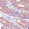 Immunohistochemistry of paraffin-embedded Human colon carcinoma using WNT10B Polyclonal Antibody at dilution of  1:100 (40x lens).