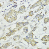 Immunohistochemistry of paraffin-embedded Human mammary cancer using CCNB1 Polyclonal Antibody at dilution of  1:100 (40x lens).