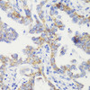 Immunohistochemistry of paraffin-embedded Human lung cancer using TOM20 Polyclonal Antibody at dilution of  1:100 (40x lens).