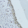 Immunohistochemistry of paraffin-embedded Human mammary cancer using NR1I3 Polyclonal Antibody at dilution of  1:200 (40x lens).