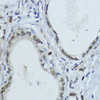 Immunohistochemistry of paraffin-embedded Human gastric cancer using NR1I3 Polyclonal Antibody at dilution of  1:200 (40x lens).