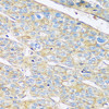 Immunohistochemistry of paraffin-embedded Human liver cancer using ARL4A Polyclonal Antibody at dilution of  1:100 (40x lens).