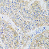 Immunohistochemistry of paraffin-embedded Human uterine cancer using ARPC1A Polyclonal Antibody at dilution of  1:100 (40x lens).