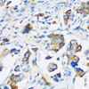 Immunohistochemistry of paraffin-embedded Human lung cancer using ARFIP2 Polyclonal Antibody at dilution of  1:100 (40x lens).