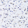 Immunohistochemistry of paraffin-embedded Human breast cancer using ARL6IP4 Polyclonal Antibody at dilution of  1:100 (40x lens).