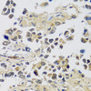 Immunohistochemistry of paraffin-embedded Human lung cancer using C12orf10 Polyclonal Antibody at dilution of  1:100 (40x lens).