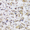 Immunohistochemistry of paraffin-embedded Human breast cancer using C12orf10 Polyclonal Antibody at dilution of  1:100 (40x lens).