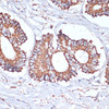 Immunohistochemistry of paraffin-embedded Human colon carcinoma using UBE2O Polyclonal Antibody at dilution of  1:100 (40x lens).